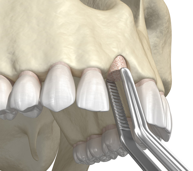 Berkeley Heights Bone Grafting for Dental Implants