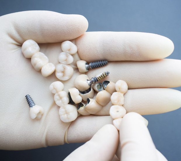 Berkeley Heights Crowns vs. Implants