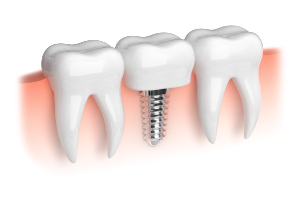 Dental Implant Recovery: What To Expect After The Procedure