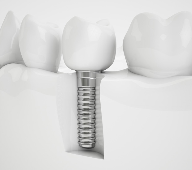 Berkeley Heights Dental Implants